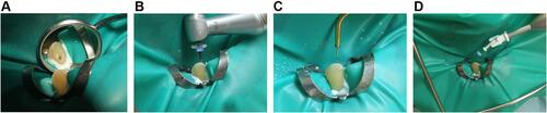 Figure 8 (A) No bleeding was observed immediately after endodontic access opening. (B) Instrumentation of the root canal using an iRace rotary endodontic instrument. (C) Passive ultrasound irrigation with an ultrasound tip. (D) Treating the root canal with ozone gas.