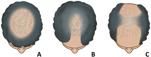 Figure 1 Female pattern hair loss subtypes: (A) Ludwig subtype, diffuse hair thinning of the centroparietal scalp with frontal hairline preservation; (B) Olsen subtype, diffuse centroparietal hair thinning with breaching of frontal hairline resembling Christmas tree; and (C) Hamilton-Norwood subtype, recession of frontal hairline in bitemporal pattern and vertex hair thinning.