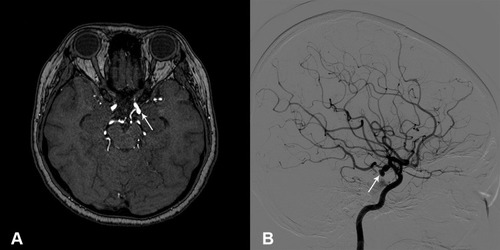 Figure 2 (A) MRA demonstrating a left posterior communicating artery aneurysm (arrow), (B) Digital subtraction angiogram demonstrating a lobulated aneurysm (arrow) at left posterior communicating artery origin.