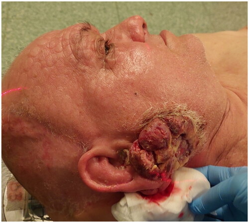 Figure 4. One year after the surgery, clinical progression of the disease was evident.