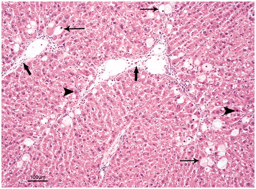 Figure 2. CCL4-treated group: Hydropic degeneration (fine arrows) and coagulation necrosis (arrow heads) in the hepatocytes, and fibrous bands extending from periacinar regions to parenchyma. Hematoxylin–eosin, bar = 100 µm.