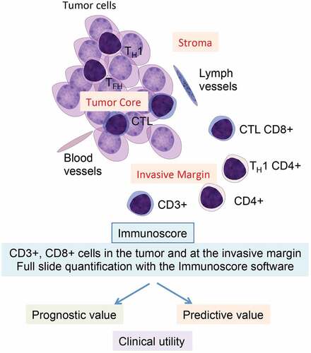 Figure 1. Clinical utility of Immunoscore. The tumor anatomy, including the tumor core, the invasive margin, and different T-cell subpopulations is illustrated. Immunoscore is a powerful prognosis marker and a predictive marker of response to chemotherapy for stage III colon cancer patients. CTL, cytotoxic T lymphocyte; TFH, T follicular-helper; TH1, T helper type 1.