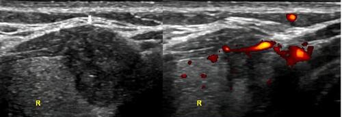 Figure 1 Thyroid papillary carcinoma locating in the anterior side is found blurry boundary with capsular, even extrusion feature in the gray US (arrow). But the missing of transcapsular blood flow lead to the judgment of min-ETE. The postoperative pathological results is displayed as invasion of cervical banded muscle.