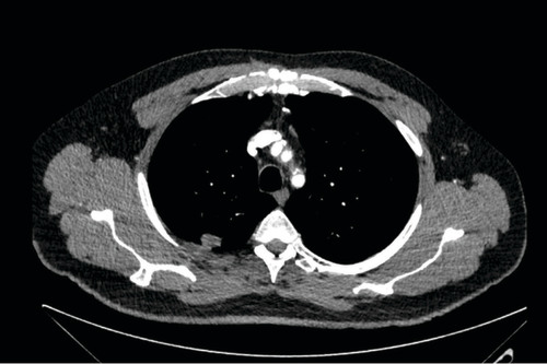 Figure 1. Computed tomography chest from May 2016 showing 18 mm nodular lesion in the posterior aspect of the right upper lobe in contact with the pleura.