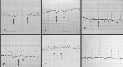 Figure 2 Electrocardiographic analysis in DII at 25 mm, of seropositive dogs to Trypanosoma cruzi, in Malinalco village, State of Mexico. (A) Sinus pacemaker; (B) aberrant conduction complex QRS; (C) sinus arrhythmia, normal in dogs; (D) wave R, electric alternating; (E) wave S deep; (F) normal.