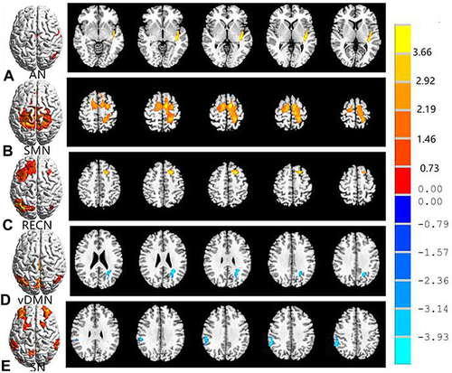 Figure 2 Brain regions with significant differences for eight RSNs in the PD group vs the HC group (two-tailed, voxel-level P < 0.01, GRF correction, cluster-level P < 0.05). Compared with HC group, Cool colors indicated the decreased functional connectivity and hot colors indicated the increased functional connectivity in the PD group. (A–E) correspond to different resting-state networks. AN, SMN, RECN, vDMN and SN.