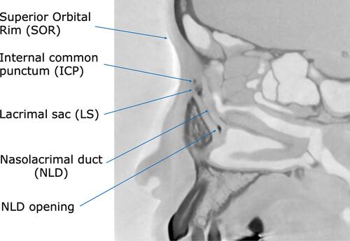 Figure 3 CBCT-DCG sagittal image sectioning the lacrimal duct. The figure shows a dacryocystographic image of the nasolacrimal duct on the right side from a patient diagnosed with left-sided unilateral primary acquired nasolacrimal duct obstruction. The original image was converted to monochrome to facilitate observation of the contrast media.