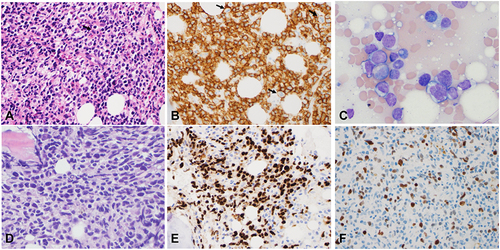 Figure 1 Bone Marrow Biopsy Case #1. The initial bone marrow biopsy of case #1 revealed infiltrating large, atypical lymphocytes with open chromatin and prominent nucleoli (A, H&E stain x 40) which were positive for CD20 (B, IHC x 40). The black arrows in A and B indicate frequent mitosis. Three years later, repeat bone marrow biopsy with roll prep-smear demonstrated recurrent lymphoma (C, WG stain x 50; D, H&E x 40). The neoplastic lymphocytes were positive for PAX5 (E, IHC x 20) and showed a high proliferative rate with a Ki-67 of 60% (E and F, IHC x 40).