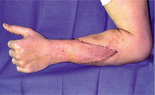 Figure 3. (a) Clinical signs of acute rejection of the skin in the second US hand transplant recipient. Note the maculopapular rash and edema in the donor allograft, in the proximal triangular area.