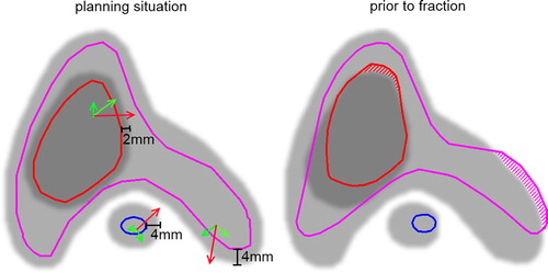 Figure 1. Schematic illustration of the three fair territories = margin-extended volumes. Left panel: planning situation: Delineated are the tCTV (red), pCTV (pink), spinal cord (blue) and their respective fair territories in shades of grey. Right panel: Same VOIs re-contoured on the changed anatomy prior to the optimised correction. Hatched areas indicate the volume fractions which are minimised in the optimisation process. Green arrows: Allowed voxel motion that does not violate the constraint for optimisation. Red arrows: Voxel motion that violates the constraint.