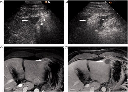 Figure 3. A 42-year-old woman with metastatic liver cancer in the left lobe of the liver. (A) Ultrasound shows a 1.7-cm hypoechoic nodule (arrow) located at the edge of hepatic segment III adjacent to the stomach (arrowheads). (B) After the induction of artificial ascites (*), the stomach (☆) is successfully separated from the ablated area (arrow). (C) Transverse contrast-enhanced MRI before MW ablation shows a tumour (arrow) with ring enhancement located at the edge of segment III adjacent to the stomach. (D) Transverse contrast-enhanced MRI 1 month after MW ablation shows that the tumour is completely ablated (arrow).