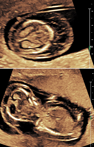 Figure 7 Upper panel: First-trimester septated cystic hygroma diagnosed at 11 and 2/7 weeks’ gestation. Lower panel: Note marked sacculation extending caudally, and overall subcutaneous edema, consistent with nonimmune fetal hydrops (NIHF). Non-invasive prenatal screening depicted 45,X (Monosomy X, Turner’s syndrome). The patient declined invasive testing and elected continued expectant management (despite being counseled regarding the likelihood of subsequent fetal demise). Gradual resolution of the septated cystic hygroma and subcutaneous edema was documented. At 22 weeks’ gestation amniocentesis confirmed 45,X Mid-trimester fetal echocardiography depicted mild left ventricular hypoplasia, with dilatation of the right side of the heart, and dilated coronary sinus suggestive of persistent left superior vena cava, findings which remained present at 30 weeks’ gestation. At 39 weeks’ gestation the patient underwent induction of labor due to preeclampsia without severe features, and delivered a vigorous non-hypoxic, non-acidotic female infant with Apgar scores of 9 and 9 at 1 and 5 minutes, respectively. The infant manifested phenotypic features of 45,X including excess neck folds, low hairline, wide spaced nipples, and bilateral dorsal lymphedema of the feet. Neonatal echocardiogram revealed significant ventricular discrepancy with significant bowing of the intraventricular septum into the left ventricle. Moderate tricuspid regurgitation was noted with peak gradient of 36 mmHg. A bicuspid aortic valve and juxtaductal coarctation of the aorta (CoA) were noted, with the isthmus measuring less than -3 z score. Turbulent flow was seen across the isthmus with peak gradient of 25-30 mmHg. On Day 11 of life, the then critically-ill infant (severe coarctation and hypoplastic aortic arch with severe left ventricular dysfunction, requiring mechanical ventilation for cardiorespiratory failure), underwent successful surgical correction (median sternotomy, cardiopulmonary bypass with aortic arch repair and end to end anastomosis). The infant did well, and echocardiogram prior to discharge confirmed an unobstructed aortic arch, and normal biventricular function.