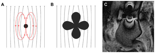 Figure 1 Diagram demonstrating a point or spherical ferromagnetic body placed in a static magnetic field (A), which will become highly magnetized, forming a dipole aligned with the outside field. The field lines of this dipole alternately align with and oppose the outside magnetic field, producing a “four-leaf clover” pattern of susceptibility artifact (B). In-plane frequency misregistration causes alternating bands of signal loss and signal pile-up (C).