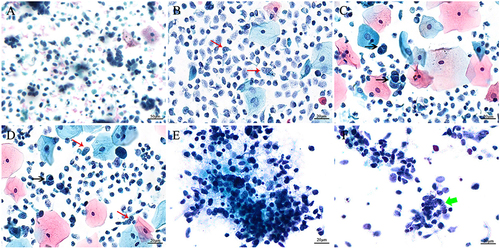 Figure 1 Liquid-based cytological morphology of cervical small cell neuroendocrine carcinoma. (A) Tumor cells are arranged in small clusters, and single cells are scattered (ThinPrep, Papanicolaou staining, 200×). (B–D) Dense tumor cells are predominantly single and scattered, with scanty cytoplasm, typical nuclear molding (shown by black arrows), chromatin stippling, a few small nucleoli (shown by red arrows) and nuclear debris, and superficial or intermediate squamous epithelial cells and neutrophils in the background (ThinPrep, Papanicolaou staining, 400×). (E) Tumor cells have mild nuclear smearing; nuclear debris and tumor diathesis are seen in the background (SurePath, Papanicolaou staining, 400×). (F) Occasional rosette-like or pseudoglandular arrangement of tumor cells was observed (shown by green arrow) (SurePath, Papanicolaou staining, 400×).