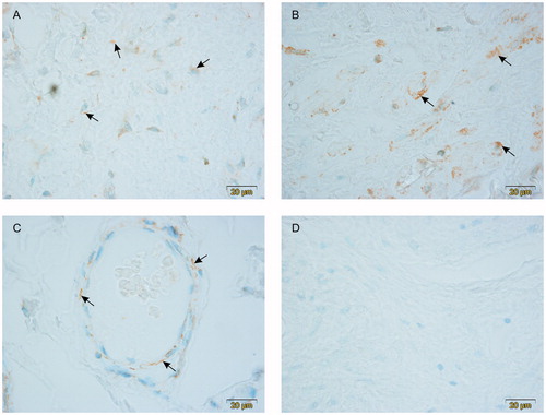 Figure 1. Expression of LHCG receptors in the human penis. Positive cells are pointed by arrows. Note the presence of LHCG receptors in the endothelial cells of the cavernous spaces in corpus spongiosum penis (A) and corpus cavernosum penis (B). Positive immunoreaction is also present in the endothelial cells of the capillary wall (C). No positive cells were present in negative controls (D). All photographs were taken using the ×100 objective. The scalebar is on the lower right corner of the figures.