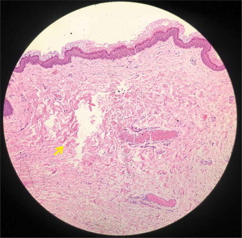 Figure 5. Histology from specimen No.5 demonstrating intra-dermal LIC (Hematoxylin and eosin (H&E), 100X).