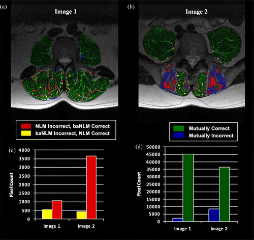 Figure 7 Automatic segmentation accuracy of muscle tissue for two different MR images (a),(b). Each image was processed independently with baNLM () and NLM (), and then classified with FCMs clustering. The classification results of the images from both filters are overlayed on a single image and coded based on correspondence of the classification results. The right-hand bars of (d) depicts regions where baNLM and NLM were mutually correct, while the left-hand bars of (d) indicates where they were mutually incorrect (b),(d). The right-hand bars of (c) indicates that baNLM was correct and NLM was incorrect, while the left-hand bars of (c) indicates that NLM was correct and baNLM was incorrect (a),(c). Incorrectly classified pixels were identified as both false-positives and false-negatives, while correctly identified pixels were associated with only true-positive muscle tissue. The classifications from both images show that baNLM (left-hand bars of (c)) had significantly less mutually exclusive misclassifications than NLM (right-hand bars of (c)) in both images (c).