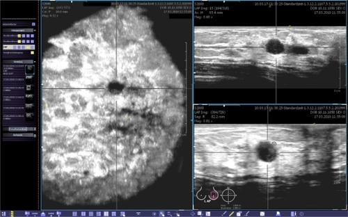 Figure 4 This view provides the coronal (left), transverse (upper right) and sagittal (lower right) planes. The body marker indicates that this volume was acquired at the apex of the left breast. The yellow spot marks the position of the nipple. A point of interest can be chosen and marked by two orthogonal lines. Then, the corresponding cross-sections are calculated in real-time and shown in the other planes. The images can be optimized by adjusting the magnification, brightness, and contrast.