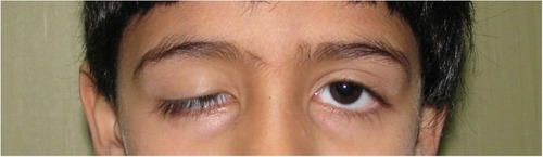 Figure 1 Upper eyelid interferes with the visual axis causing stimulus deprivation or induces amblyogenic astigmatism.