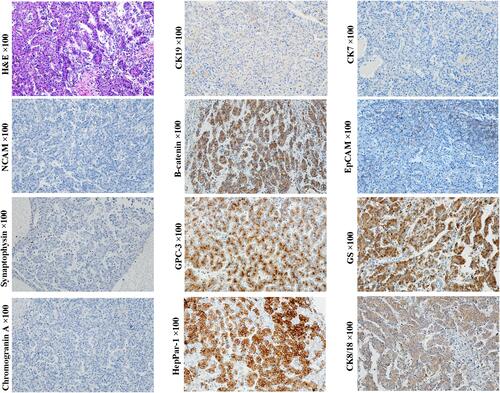 Figure 10 Example case of a pure fetal HB originated from the HCP. A 1-year-old female patient with 11 cm sized tumor in the right lobe of the liver. The preoperative serum AFP level >1210 ng/mL. Lung metastasis was found at 18 months after extended right hemihepatectomy. Homogeneous tumor cells are arranged in trabecular or acinar patterns, which closely resemble an HCC. Tumor cells express CK8/18, GPC3, β-catenin (cell membrane) and CK19 (scattered), but not NCAM, chromogranin, synaptophysin, CK7, and HepPar1. EpCAM is negatively stained in the typical thin trabecular structure, while it is expressed in the cell membrane in the adjacent small cell crowded area. Glutamine synthetase is expressed dispersedly. This immunohistochemical profile is consistent with that of the HCP, whereas not hepatoblast or HPC.