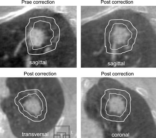 Figure 2.  Registration of planning CT study and verification cone-beam CT (CB-CT) study: Structures of the ITV (inner contour) and the PTV (outer contour) are projected into the CB-CT study and adjusted to the tumor position at time of treatment.