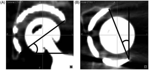 Figure 3. Postoperative measurement of the acetabular component position using image-processing software. The radiographic abduction angle was measured on the coronal view (A) and the anatomic anteversion angle was measured on the axial reconstruction view (B) at the same references used in planning.