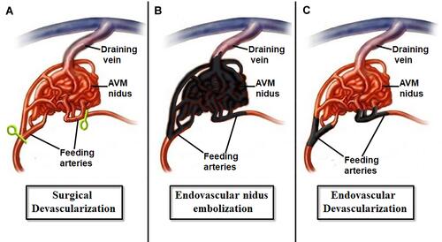 Figure 1 Schematic drawing demonstrating various approaches to AVM. (A) Intra-operative clip or coagulation devascularization during surgical resection. (B) Endovascular nidus embolization. (C) Endovascular feeders occlusion (devascularization) prior surgical resection.