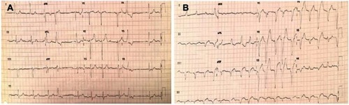 Figure 1 ECG baseline before starting nivolumab treatment: sinus rhythm at 60 bpm with isolated extrasystoles (A). ECG at myocarditis clinical onset: atrial fibrillation and left bundle branch block (B).