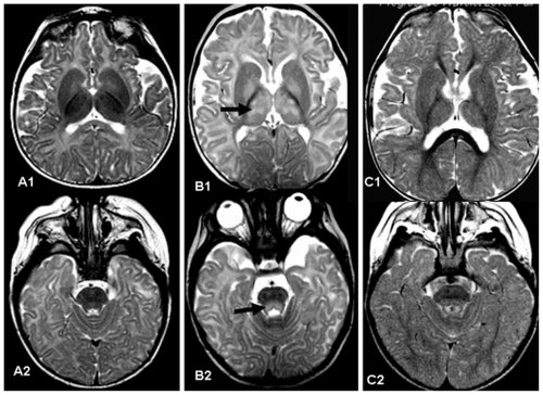 Figure 3 A1 and A2) show axial T2 weighted images of a normal baby aged five months. B1 and B2) show a five-month-old patient who had received vigabatrin for eight weeks. The magnetic resonance image was obtained due to abnormal eye movement. Magnetic resonance imaging shows high T2 weighted intensity in the thalamus and globus pallidus (arrow in B1) and tegmental portion of the pons (arrow in B2). Vigabatrin was discontinued. C1 and C2) Follow-up magnetic resonance imaging of the same patient three months later shows normal signal in the thalamus and pontine tegmentum.