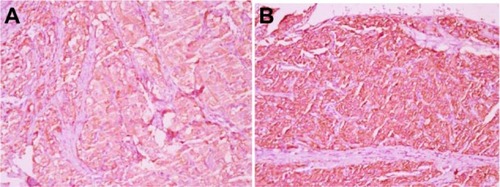 Figure 3 Positive immunohistochemical staining for chromogranin (400×) (A); positive immunohistochemical staining for synaptophysin (400×) (B).