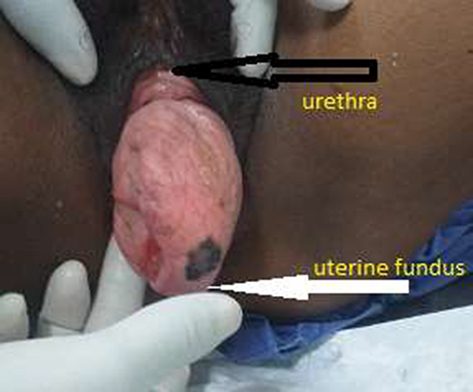 Figure 1 Gross appearance of inverted uterus, the photo taken on supine position.