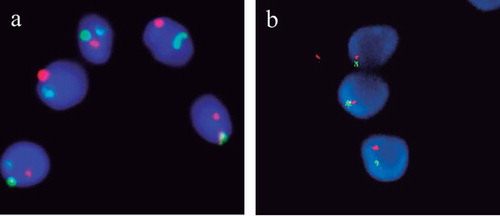 Figure 2. Example of sperm FISH result. (A) Triple color FISH for chromosomes X (green), Y (red), and 18 (blue). (B) Double color FISH for chromosomes 13 (green) and 21 (red). FISH: fluorescent in situ hybridization.
