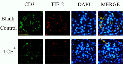 Figure 18 The location of Tie-2 (×400). Tie-2 was mainly expressed on endothelial cells. Yellow arrow: endothelial cells.