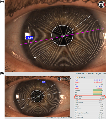 Figure 3 Measurement of HVID (A) and palpebral aperture (B). In (B), on the right, information about the pupil is also provided.