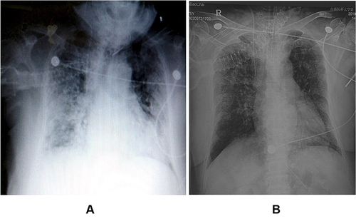 Figure 2 Chest X-ray examination after admission (A) on July 7, 2019, when the condition worsened; (B) on July 8, 2019, when the condition improved slightly.