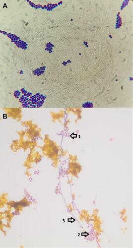 Figure 1 Light microscopy for histopathology smears of infected bile (400×), (A) budding yeast (B) Candida albicans demonstrating chlamydospores (arrow 1), blastospores (arrow 2) and pseudohyphae (arrow 3).