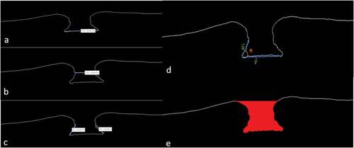 Figure 2. Different measurements: (a) basal diameter; (b) macular hole diameter; (c) right and left arm; (d) angle diameter; (e) macular hole volume.