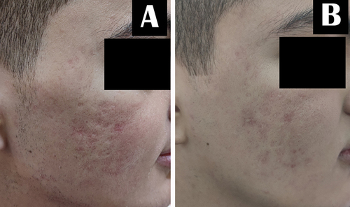 Figure 2 A 20-year-old male patient with atrophic acne scars. (A) Before treatment. (B) Significant improvement after treatment with fractional CO2 laser and nanofat injection.
