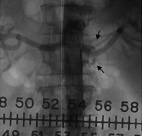 Figure 1. Aortography: arrows indicate two left renal accessory arteries.