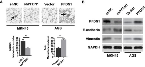 Figure 4 The effects of the alteration of PFDN1 expression on GC cells metastasis in vivo. (A) The effects of PFDN1 knockdown or overexpression on cell metastasis in nude mice. (B) Western blot analysis of the levels of PFDN1, E-cadherin and vimentin in the lung metastatic nodules. (n = 6, each group). *P<0.05.Abbreviations: PFDN1, prefoldin subunit 1; GC, gastric cancer.