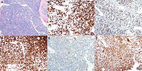 Figure 3 Bone Marrow Biopsy and IHC Staining. Bone marrow biopsy revealed a diffuse and interstitial proliferation of small to medium lymphocytes and plasma cells (A, H&E x 10). IHC studies show that the lymphocytes were strongly and diffusely positive for CD20 (B, x 20); CD138 showed increased plasma cells (C, x 20); and CD79a confirmed the lymphoplasmacytic proliferation by highlighting both neoplastic B-lymphocytes and plasma cells (D, x 20). In addition, the lymphocytes and plasma cells are negative for kappa (E, x 20) but positive for lambda (F, x 20); hence confirmed lambda light chain restriction.