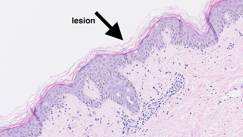 Figure 2 Histopathologic images of the patient’s skin lesions (HE × 200).The arrow in the figure indicates the precise lesion of the patient.