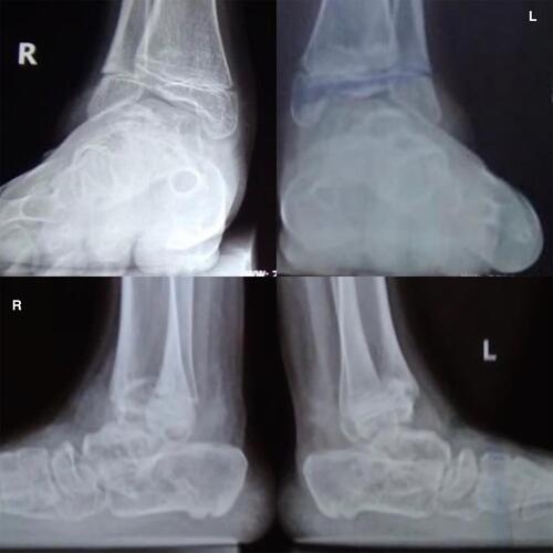 Figure 10 Weight-bearing views of both ankles at eighteen months with good function and painless ambulation.