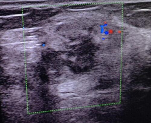 Figure 4 Breast ultrasound showing hypoechoic mass in the right breast (BI-RADS 4a) (green box).