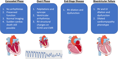 Figure 2 Four phases classically described in arrhythmogenic right ventricular cardiomyopathy and the associated findings in the 1) concealed phase where no structural changes are seen on imaging, 2) overt phase where arrhythmias may manifest and right ventricular (RV) changes may be seen on echocardiogram (ECHO) or cardiac magnetic resonance imaging (CMR), 3) end-stage disease phase where RV dilation and dysfunction is seen, and 4) biventricular disease where the left ventricle (LV) becomes involved and a dilated cardiomyopathy phenotype may manifest. Parts of the figure were drawn by using pictures from Servier Medical Art. Servier Medical Art by Servier is licensed under a Creative Commons Attribution 3.0 Unported License (https://creativecommons.org/licenses/by/3.0/).