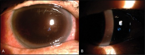 Figure 1 A slit lamp image showed the total hyphema with a dark red color expanded into the cornea stroma of the right eye from anterior view (A) and oblique view (B).