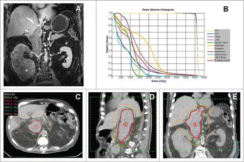 Figure 3. SABR Treatment of Unresectable IVC-TT. (A) Coronal contrast-enhanced MRI during the venous phase demonstrates low level enhancement in a large renal mass (asterisk), which infiltrates the entire right kidney parenchyma and extends superiorly with a expansile tumor thrombus in the inferior vena cava (arrowheads). Note the superior extent of the tumor thrombus (black arrow) above the diaphragm (i.e. level IV thrombus). (B) Radiation dose volume histogram from SABR plan of 45 Gy in 5 fractions showing optimized doses to critical organs and target volumes. The patient set-up and target delineation was similar to the first case. The plan required 13 non-coplanar photon beams of 10 MV and IMRT optimization to ensure >95% PTV coverage with a 0.5 cm margin on the TT. C-E) Representative axial, sagittal, and coronal images of the SABR treatment plan with isodose lines showing dose distribution and coverage of the IVC-TT.