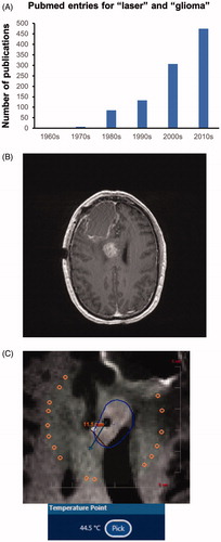 Figure 1. Laser ablation of glioma. (A) A Pubmed search for ‘laser’ and ‘glioma’ shows a striking increase in the number of publications over the past two decades. (B) Example of recurrent GBM in the corpus callosum. (C) This callosal tumor was treated with LITT at our institution. This image was captured with live MR thermography during the ablation. The white target is located on the expanding border of the predicted cell kill zone (blue contour line) and has reached a temperature of 44.5 °C. Higher temperatures were generated within the area outlined by the contour line.