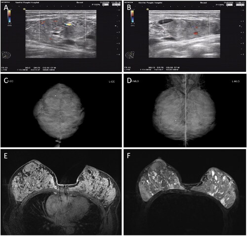 Figure 2. Preoperative color ultrasonography (A, B), mammography (C, D), and MRI (E, F) of bilateral breasts. Color ultrasonography (A, B) of the breast indicated a solid mass with a clear boundary, a low blood flow signal (A), and cystic changes. Mammography (C, D) indicated dense and lamellar bodies of both mammary glands, with no obvious nodular sensation, bilateral axillary lymph node shadows, and a few coarse calcifications in the right mammary gland. MRI (E, F) indicated dense glands in both breasts, with multiple mixed long T1 (E) and long T2 (F2) abnormal signal shadows in each quadrant. MRI, Magnetic resonance imaging.