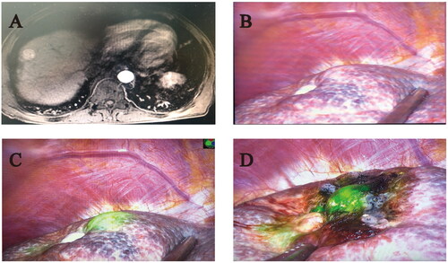 Figure 2. The tumor recurred at the same site as the initial thermal ablation site (Case 27). (A) The enhanced magnetic resonance imaging of tumor (B) Tumor imaging without ICG fluorescence imaging (C) Tumor imaging with ICG fluorescence imaging (D) Residual fluorescence was found in tumors after FLRFA.